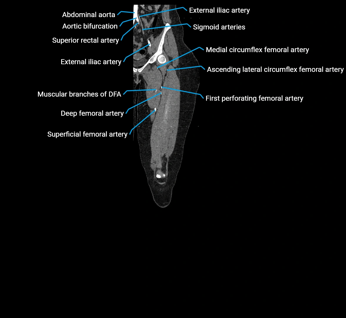 CTA lower limb coronal cross sectional anatomy labelled image _26 (3).webp